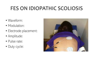 FES ON IDIOPATHIC SCOLIOSIS
• Waveform:
• Modulation:
• Electrode placement:
• Amplitude:
• Pulse rate:
• Duty cycle:
 
