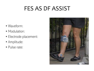 FES AS DF ASSIST
• Waveform:
• Modulation:
• Electrode placement:
• Amplitude:
• Pulse rate:
 