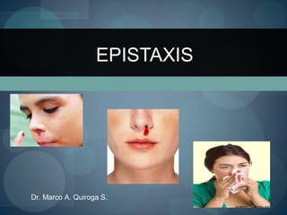 EPISTAXIS
Dr. Marco A. Quiroga S.
 