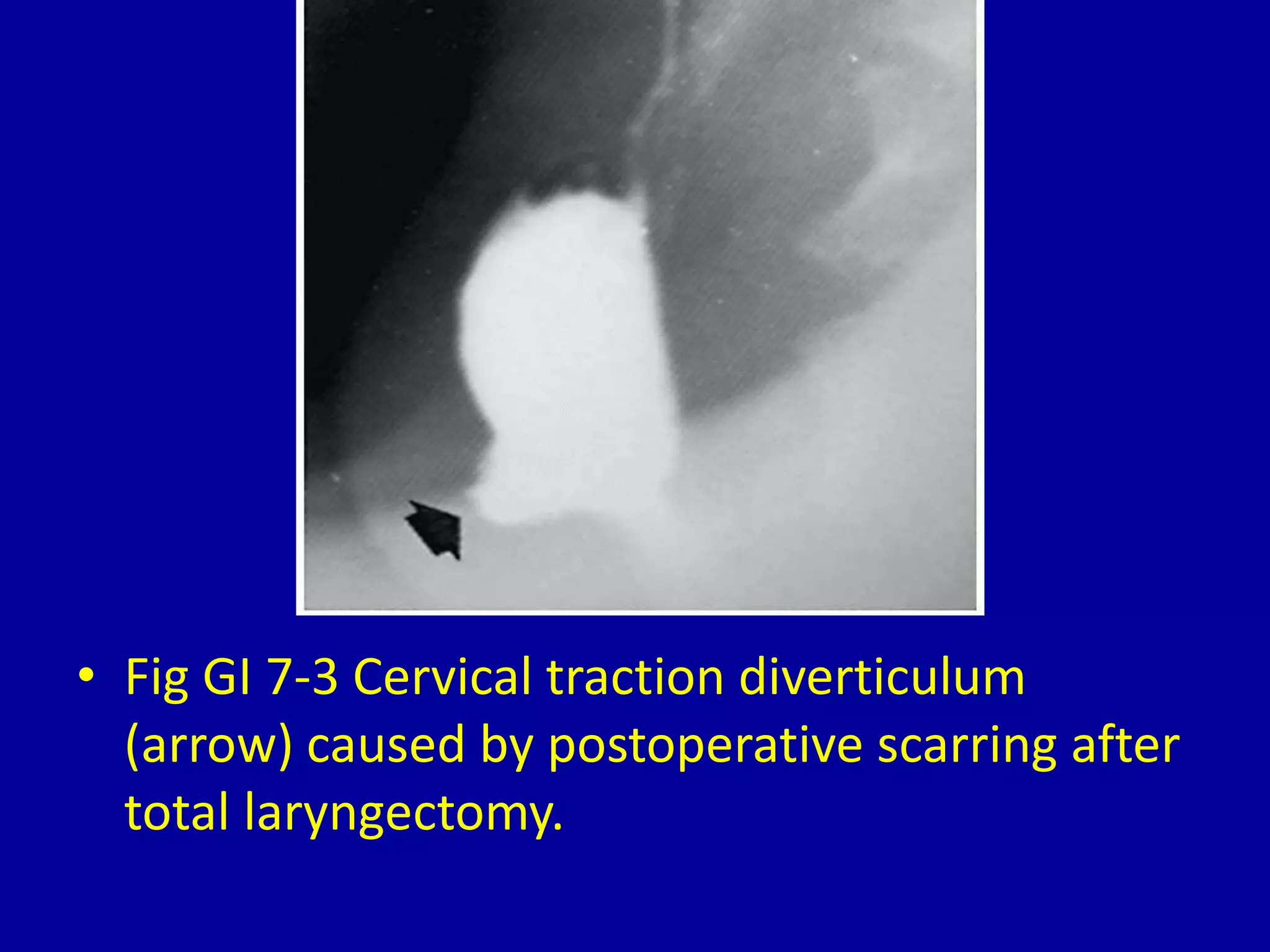 • Fig GI 7-3 Cervical traction diverticulum
(arrow) caused by postoperative scarring after
total laryngectomy.