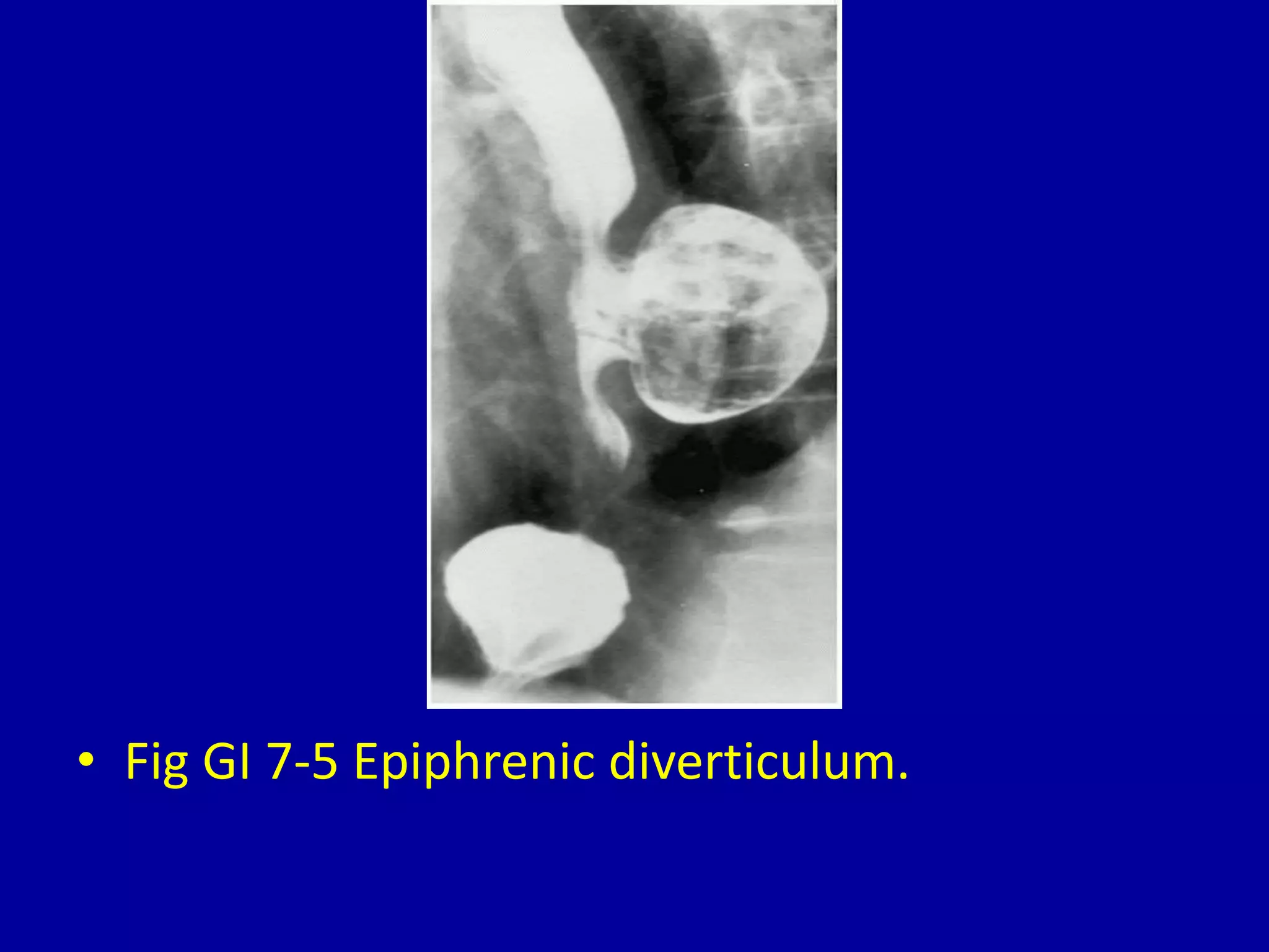 • Fig GI 7-5 Epiphrenic diverticulum.