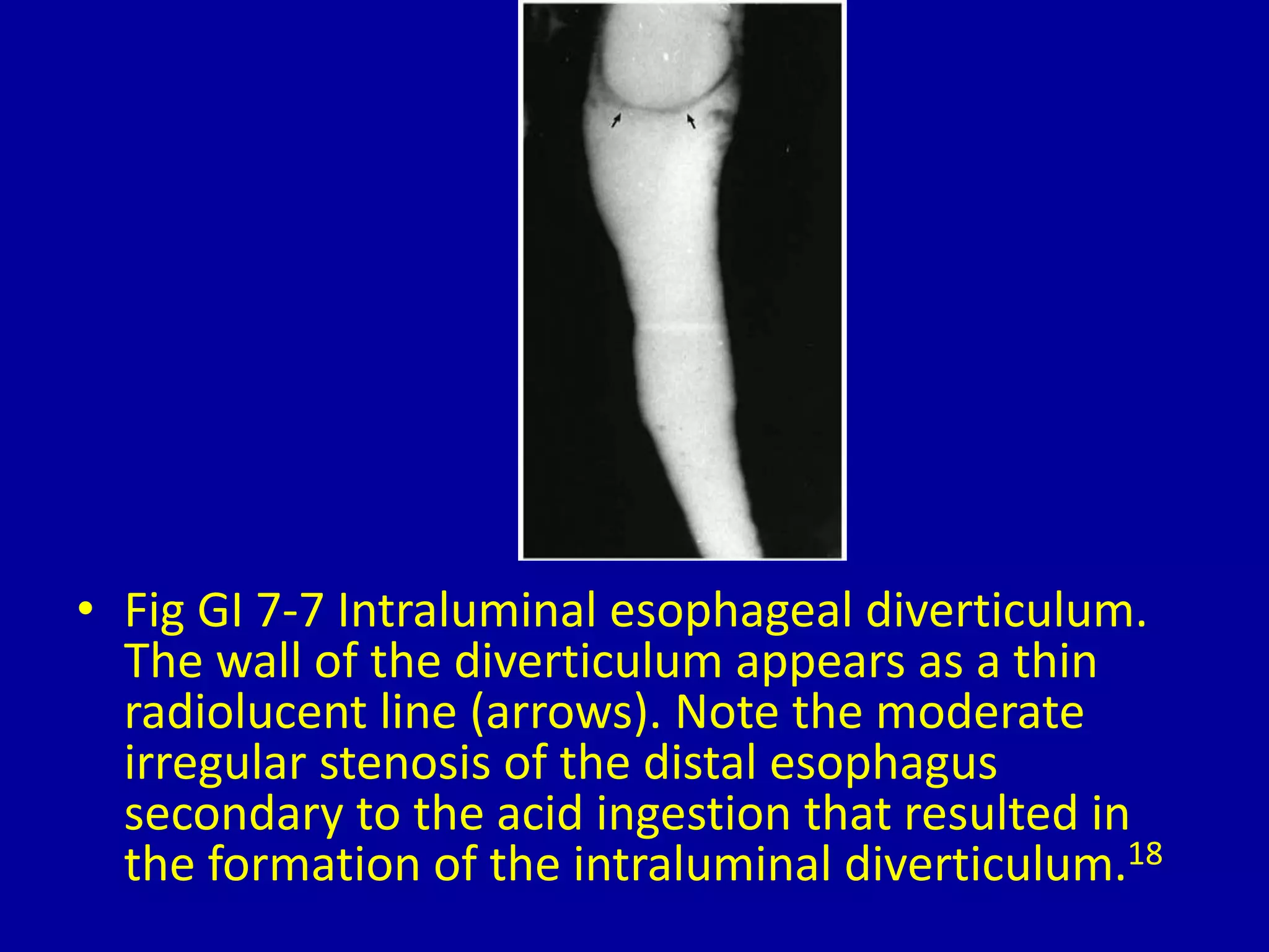 • Fig GI 7-7 Intraluminal esophageal diverticulum.
The wall of the diverticulum appears as a thin
radiolucent line (arrows). Note the moderate
irregular stenosis of the distal esophagus
secondary to the acid ingestion that resulted in
the formation of the intraluminal diverticulum.18
