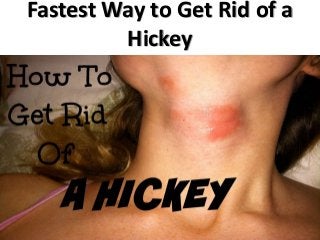 Fastest Way to Get Rid of a
Hickey
 