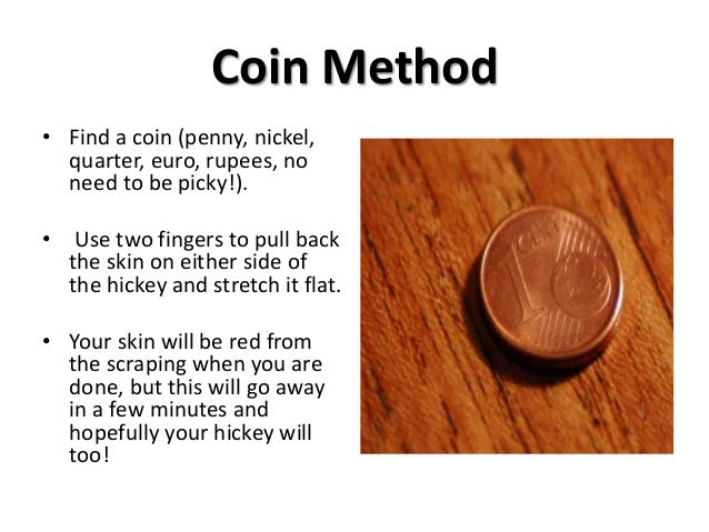 Can you get rid of a hickey with a penny?