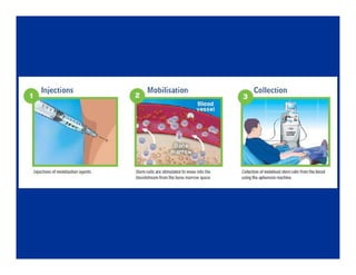 Hematopoietic stem cell transplantation in Pediatrics | PDF