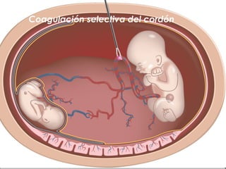  Prematurez 15.9 /1000 nv
 Retardo de crecimiento intrauterino
15.1/1000nv
 Transfusión feto fetal 11.7/1000nv
 Anomal...