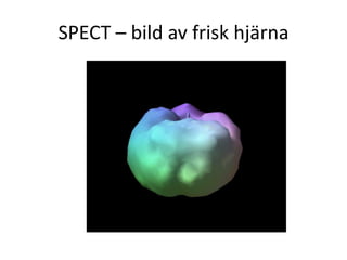 SPECT – bild av frisk hjärna
 
