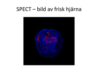 SPECT – bild av frisk hjärna
 