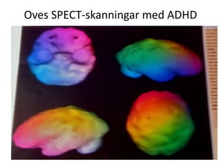 Oves SPECT-skanningar med ADHD
 