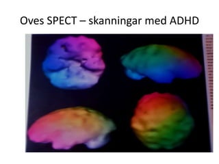 Oves SPECT – skanningar med ADHD
 