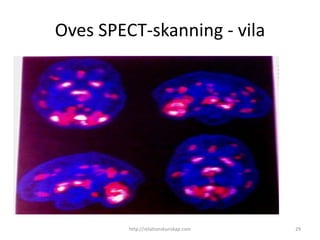 Oves SPECT-skanning - vila




         http://relationskunskap.com   29
 