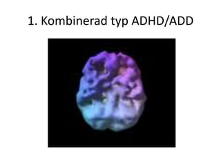 1. Kombinerad typ ADHD/ADD
 
