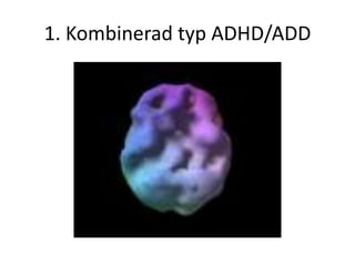 1. Kombinerad typ ADHD/ADD
 