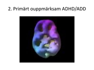 2. Primärt ouppmärksam ADHD/ADD
 