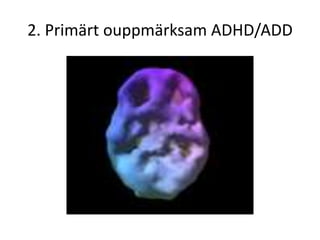 2. Primärt ouppmärksam ADHD/ADD
 