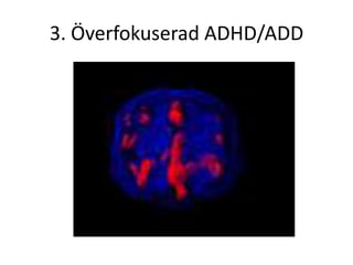 3. Överfokuserad ADHD/ADD
 