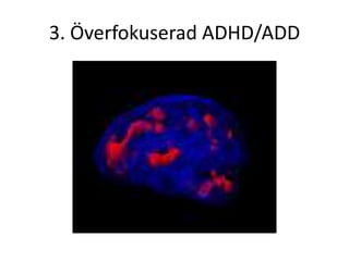 3. Överfokuserad ADHD/ADD
 