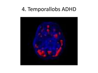 4. Temporallobs ADHD
 