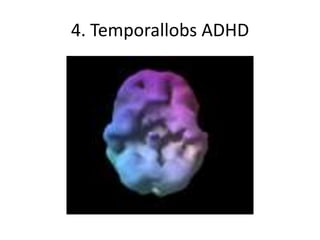 4. Temporallobs ADHD
 