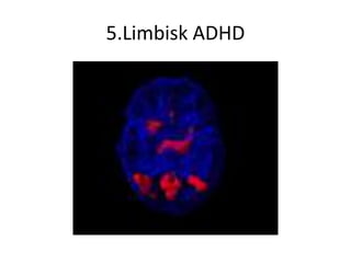 5.Limbisk ADHD
 