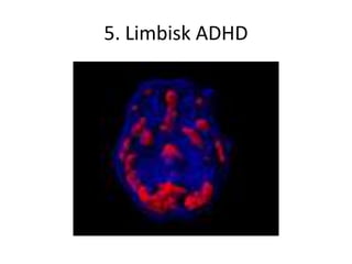 5. Limbisk ADHD
 