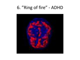 6. ”Ring of fire” - ADHD
 