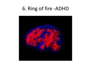 6. Ring of fire -ADHD
 