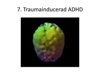 7. Traumainducerad ADHD
 
