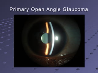 Primary Open Angle GlaucomaPrimary Open Angle Glaucoma
 