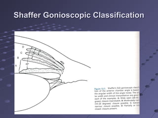 Shaffer Gonioscopic ClassificationShaffer Gonioscopic Classification
 