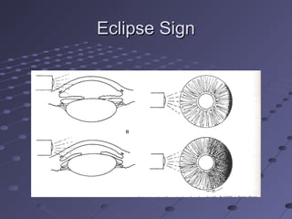 Eclipse SignEclipse Sign
 