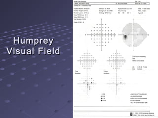 HumpreyHumprey
Visual FieldVisual Field
 