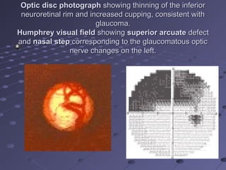 Optic disc photographOptic disc photograph showing thinning of the inferiorshowing thinning of the inferior
neuroretinal rim and increased cupping, consistent withneuroretinal rim and increased cupping, consistent with
glaucoma.glaucoma.
Humphrey visual fieldHumphrey visual field showingshowing superior arcuatesuperior arcuate defectdefect
andand nasal stepnasal step corresponding to the glaucomatous opticcorresponding to the glaucomatous optic
nerve changes on the left.nerve changes on the left.
 