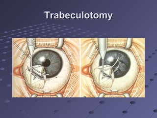 TrabeculotomyTrabeculotomy
 