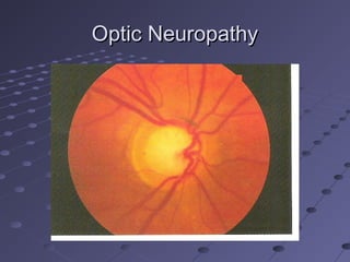 Optic NeuropathyOptic Neuropathy
 