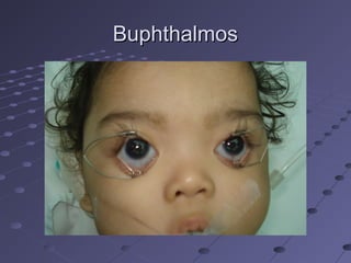 BuphthalmosBuphthalmos
 