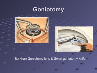 GoniotomyGoniotomy
Barkhan Goniotomy lens & Swan goniotomy knife
 