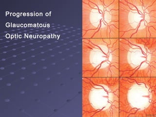 Progression of
Glaucomatous
Optic Neuropathy
 
