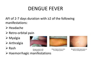DENGUE FEVER
AFI of 2-7 days duration with ≥2 of the following
manifestations:
 Headache
 Retro-orbital pain
 Myalgia
 Arthralgia
 Rash
 Haemorrhagic manifestations
 