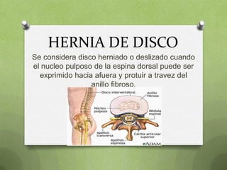 HERNIA DE DISCO
Se considera disco herniado o deslizado cuando
el nucleo pulposo de la espina dorsal puede ser
exprimido hacia afuera y protuir a travez del
anillo fibroso.

 