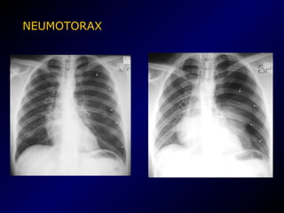 NEUMOTORAX
 