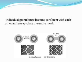 Individual granulomas become confluent with each
other and encapsulate the entire mesh
 