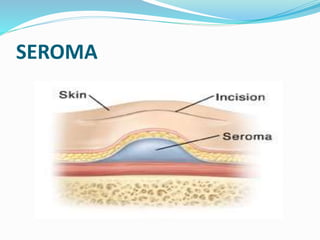 SEROMA
 