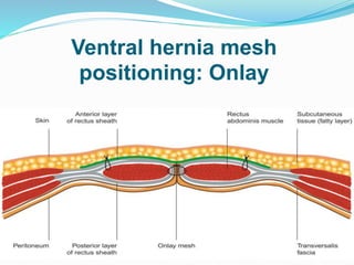 Ventral hernia mesh
positioning: Onlay
 