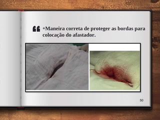 “
◈Maneira correta de proteger as bordas para
colocação do afastador.
50
 