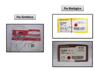 Fio Sintético
Fio Biológico
 