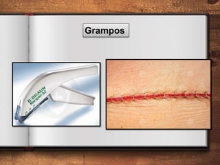 Grampos
 