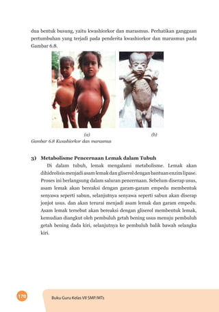 170 Buku Guru Kelas VII SMP/MTs
dua bentuk busung, yaitu kwashiorkor dan marasmus. Perhatikan gangguan
pertumbuhan yang terjadi pada penderita kwashiorkor dan marasmus pada
Gambar 6.8.
(a)	(b)
Gambar 6.8 Kwashiorkor dan marasmus
3)	 Metabolisme Pencernaan Lemak dalam Tubuh
Di dalam tubuh, lemak mengalami metabolisme. Lemak akan
dihidrolisismenjadiasamlemakdangliseroldenganbantuanenzimlipase.
Proses ini berlangsung dalam saluran pencernaan. Sebelum diserap usus,
asam lemak akan bereaksi dengan garam-garam empedu membentuk
senyawa seperti sabun, selanjutnya senyawa seperti sabun akan diserap
jonjot usus. dan akan terurai menjadi asam lemak dan garam empedu.
Asam lemak tersebut akan bereaksi dengan gliserol membentuk lemak,
kemudian diangkut oleh pembuluh getah bening usus menuju pembuluh
getah bening dada kiri, selanjutnya ke pembuluh balik bawah selangka
kiri.
 