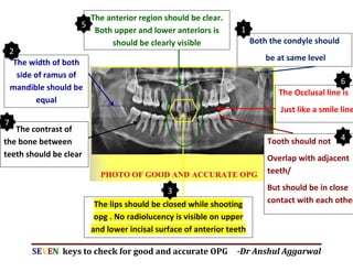 SEVEN keys to check for good and accurate OPG -Dr Anshul Aggarwal
Both the condyle should
be at same level
The width of both
side of ramus of
mandible should be
equal
The anterior region should be clear.
Both upper and lower anteriors is
should be clearly visible
Tooth should not
Overlap with adjacent
teeth/
But should be in close
contact with each other
The contrast of
the bone between
teeth should be clear
The lips should be closed while shooting
opg . No radiolucency is visible on upper
and lower incisal surface of anterior teeth
The Occlusal line is
Just like a smile line
1
2
3
4
5
6
7
 