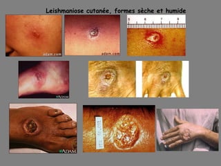 Leishmaniose cutanée, formes sèche et humide
 